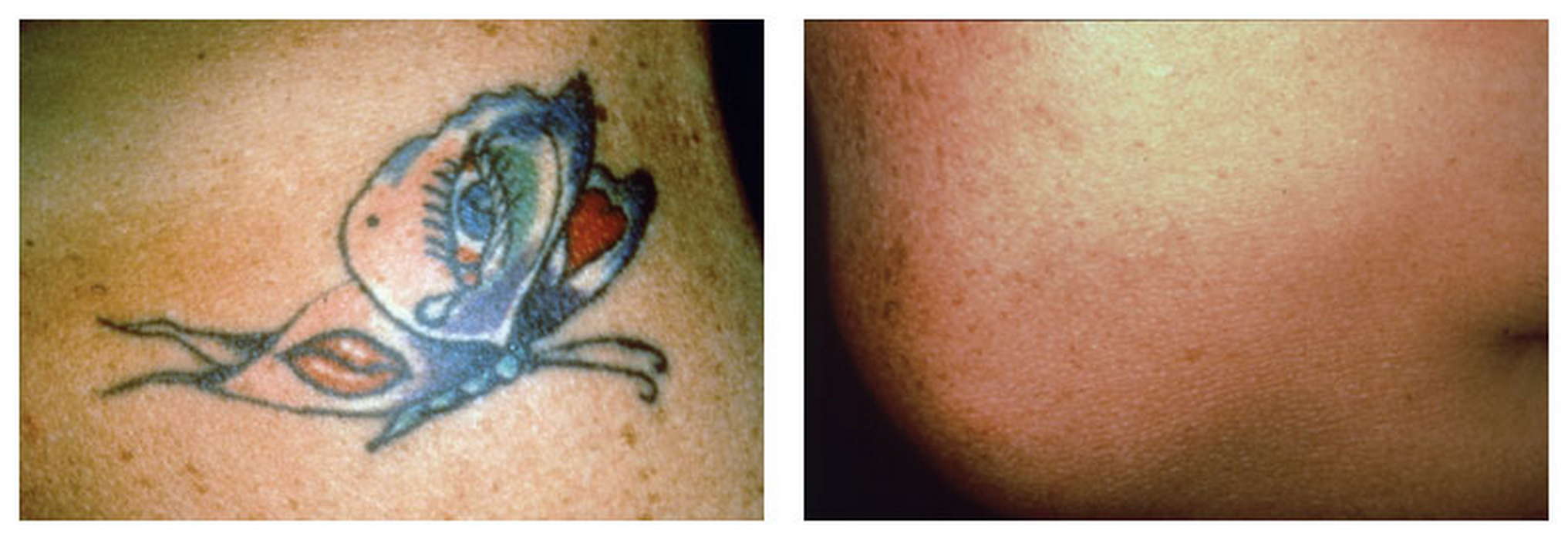 Tattoo: The technique that erases it without scars and discoloration -  Health Laser Clinic