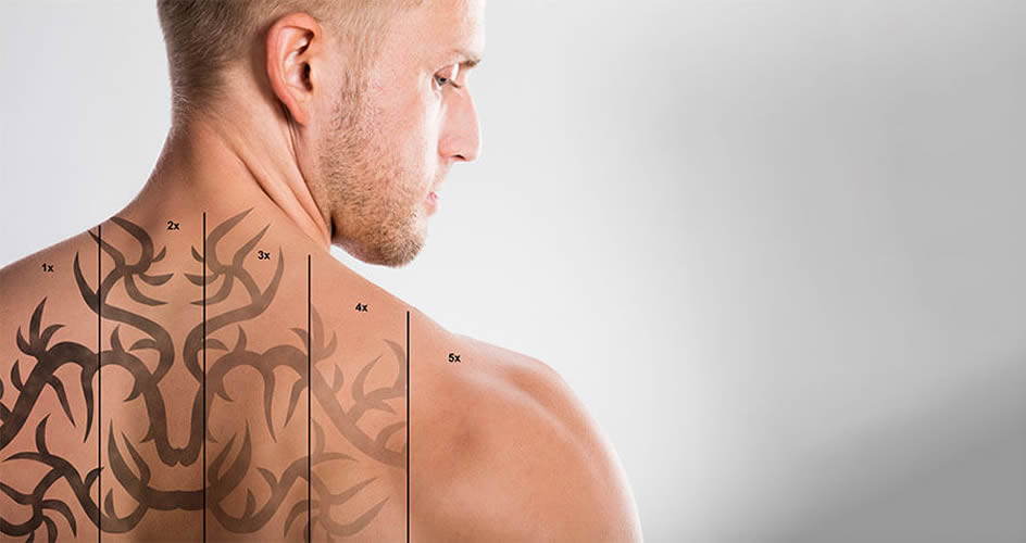 Αφαίρεση Τατουάζ